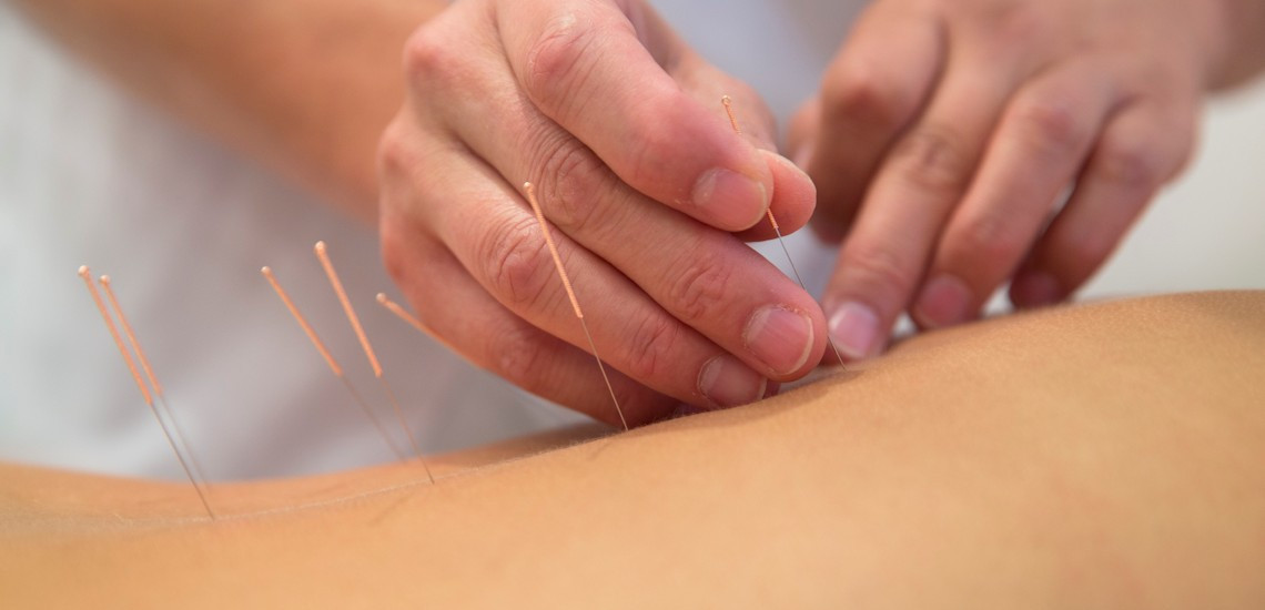 Acupuncture being performed